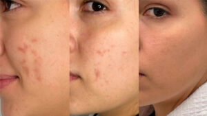 Acne-Portada
