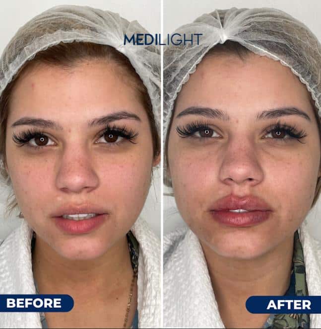 Everything you need to know about lip filler with hyaluronic acid.