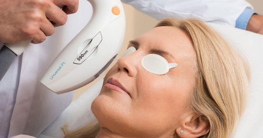 Eliminación de manchas solares con fotorejuvenecimiento IPL antes y después en Medilight Doral Miami