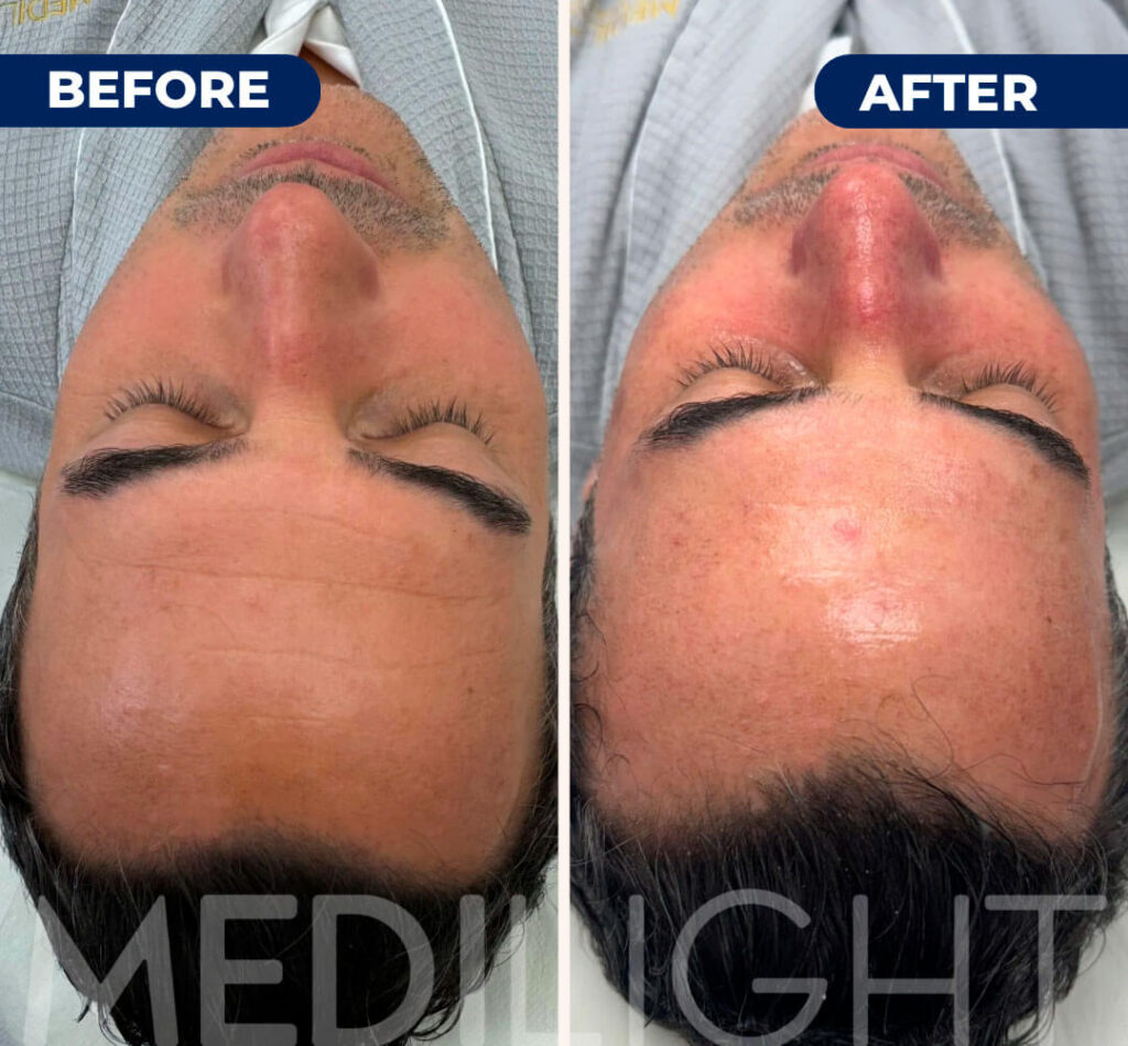 hidrafacial-antes-y-despues