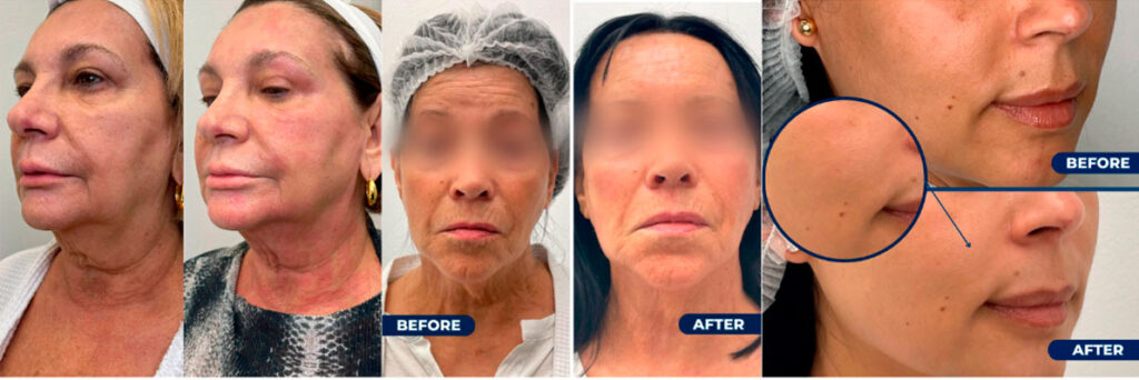 antes-y-despues-Anti-Aging