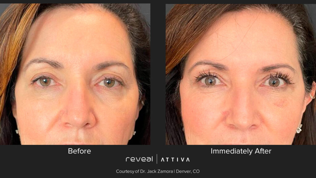 ATTIVA-antes-y-despues