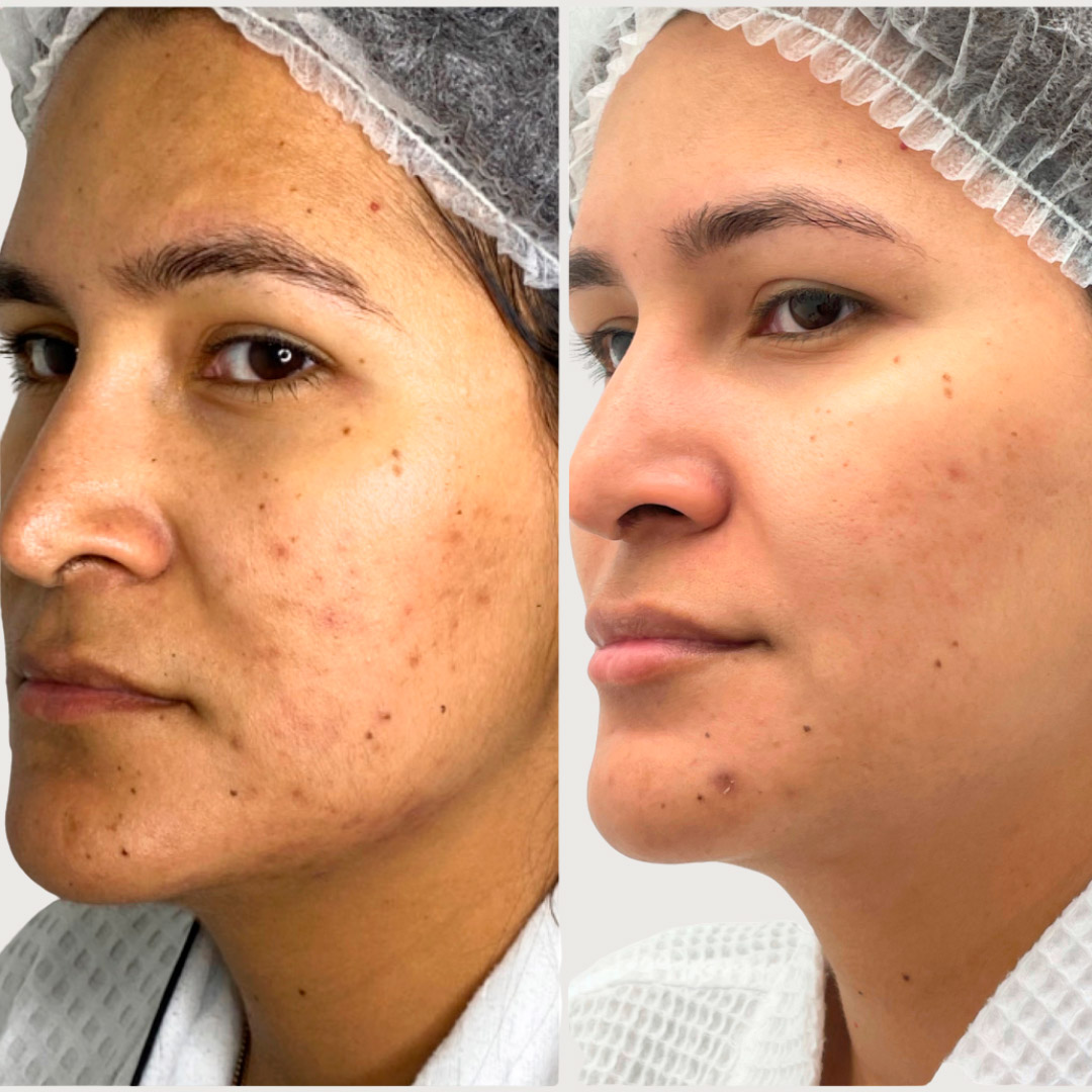 ANTES Y DESPUES