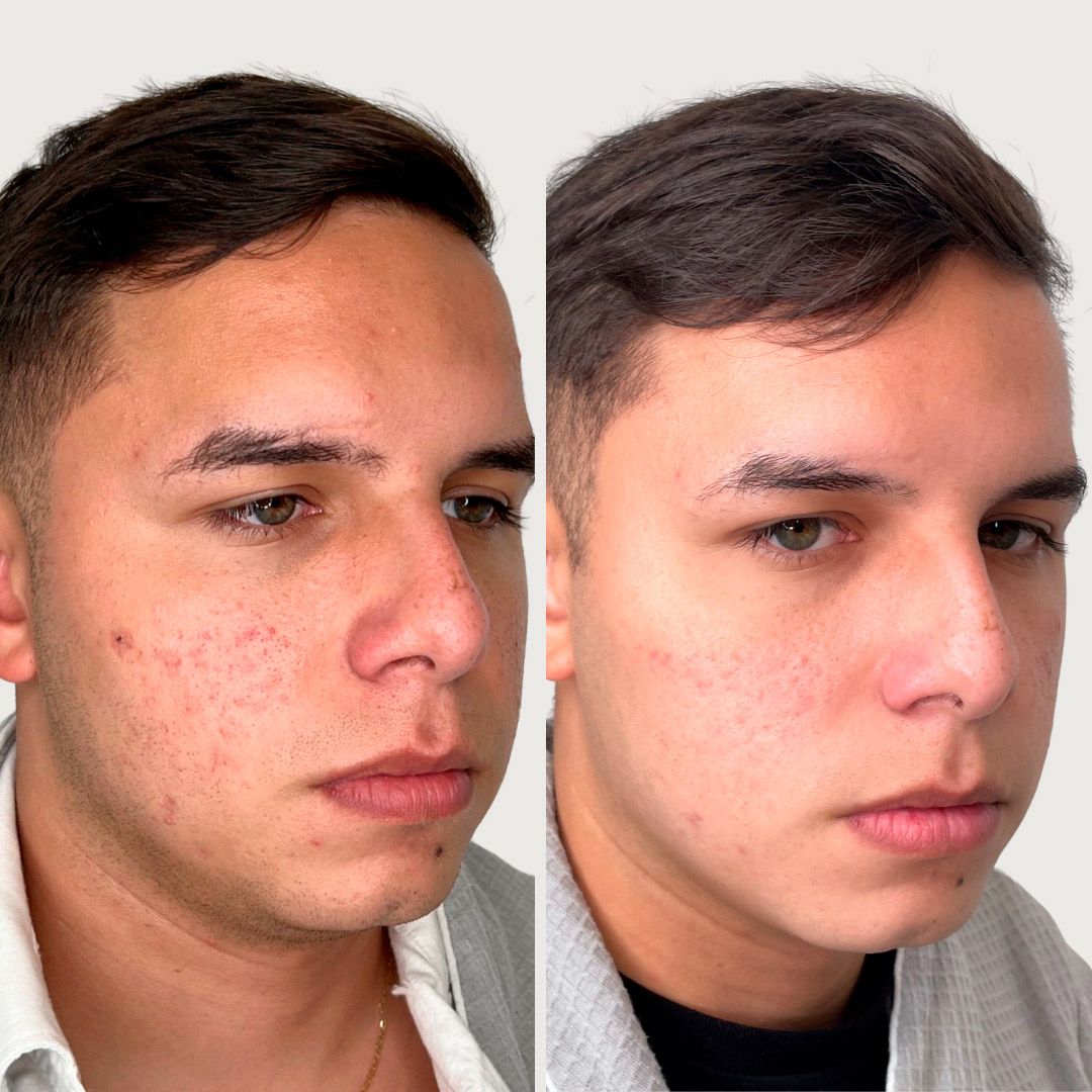 ANTES Y DESPUES