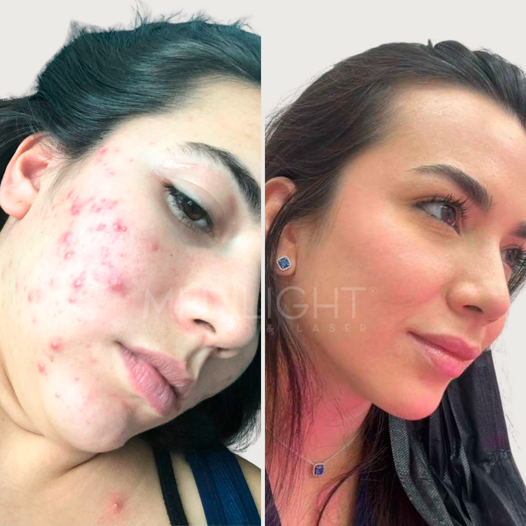 ANTES Y DESPUES